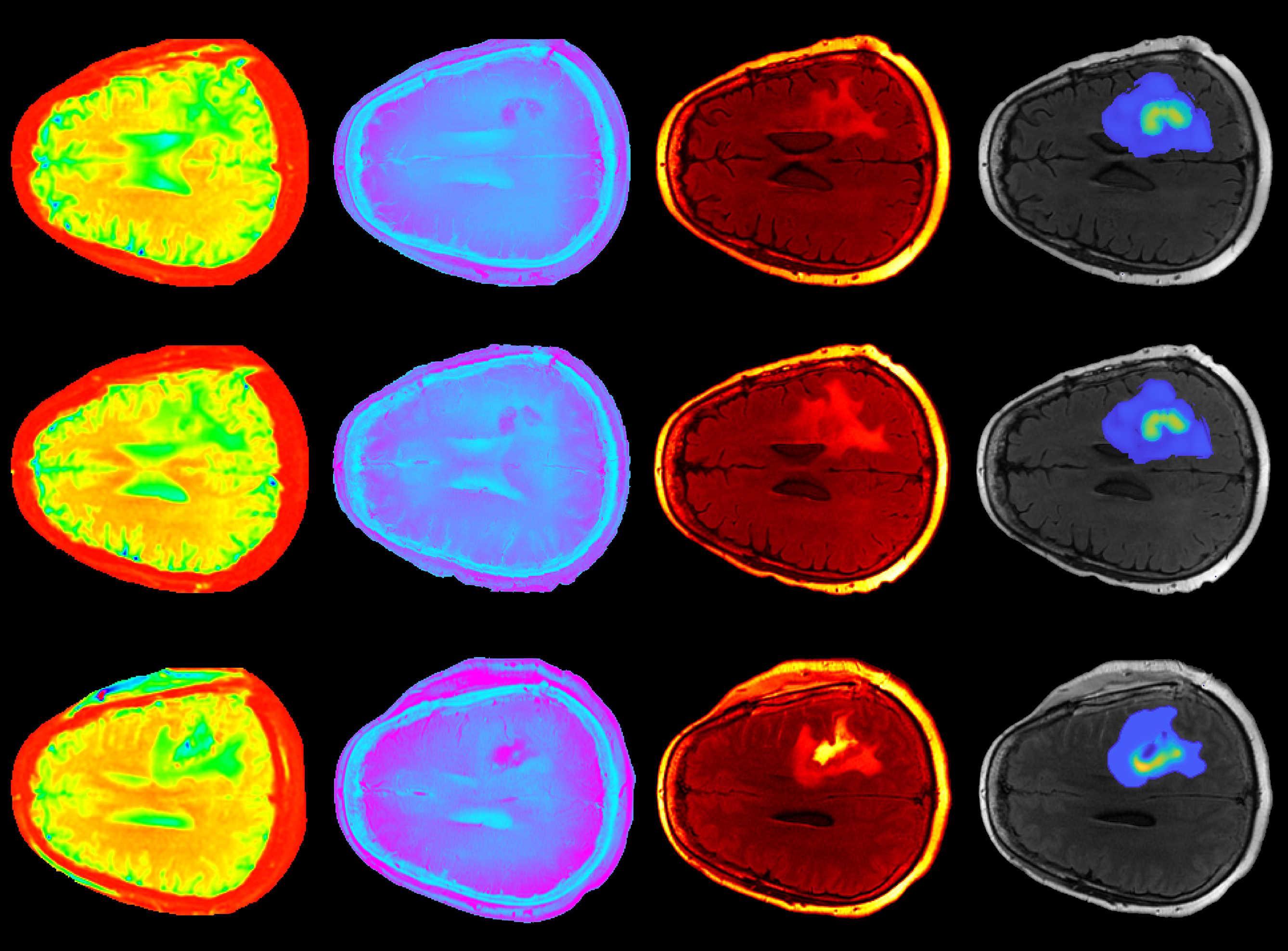 MRI data is used to personalize forecasts of response to chemotherapy and radiotherapy. Images are collected before and during radiotherapy enabling predictions of response prior to conclusion of treatment. Credit David Hormuth.