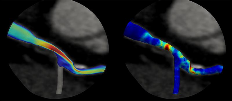 Hughes Heart Flow NSF project